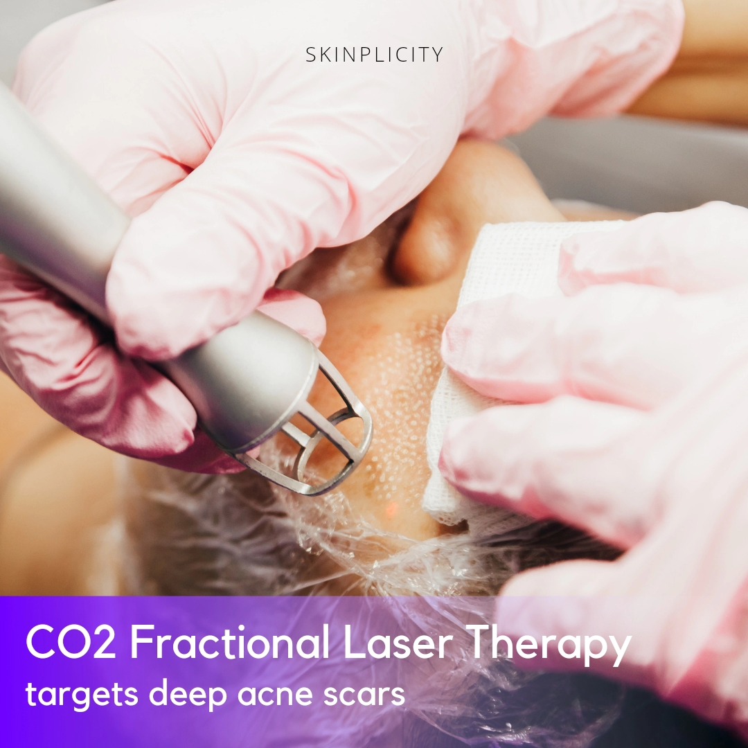 CO2 Fractional Laser Therapy