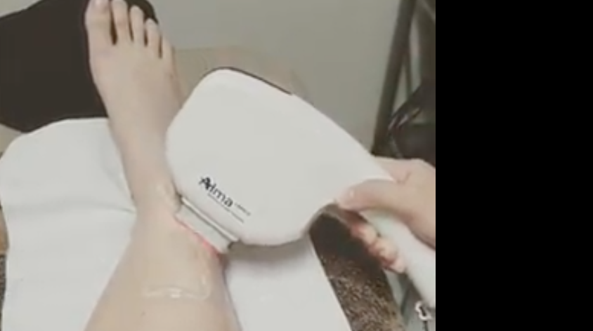 IPL Laser Hair Removal